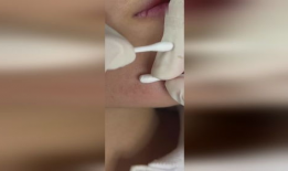 挤痘痘视频,专业视频教你正确操作